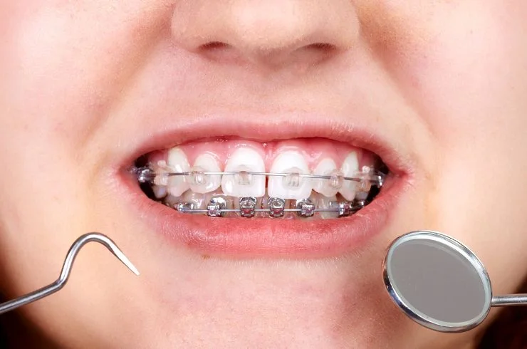 Orthodontics-5